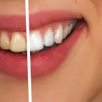 Come avere denti bianchissimi? Ecco qualche consiglio