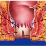 Patologia emorroidaria: nuove cure