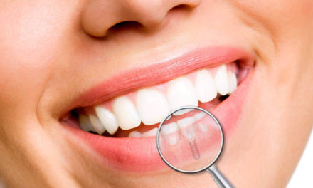 Implantologia dentale, quali sono i rischi