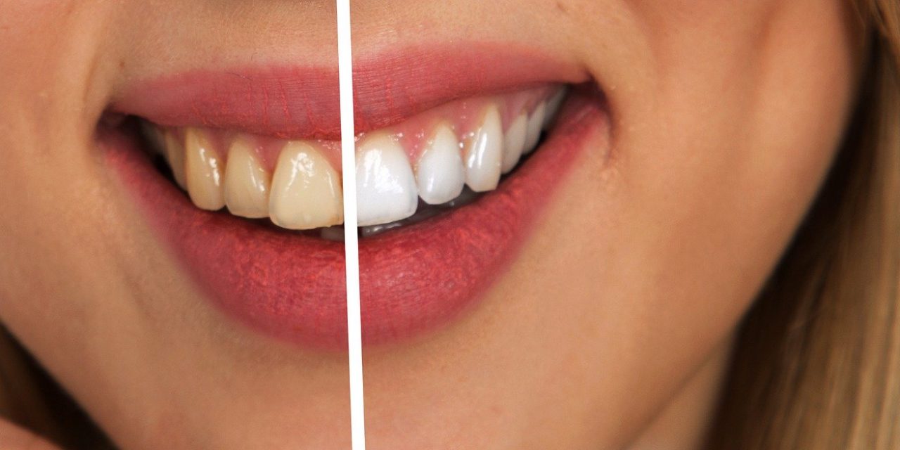 Come avere denti bianchissimi? Ecco qualche consiglio
