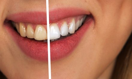 Come avere denti bianchissimi? Ecco qualche consiglio